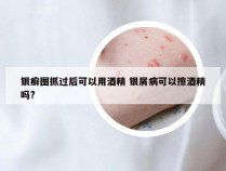 银癣图抓过后可以用酒精 银屑病可以擦酒精吗?
