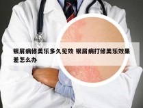 银屑病修美乐多久见效 银屑病打修美乐效果差怎么办