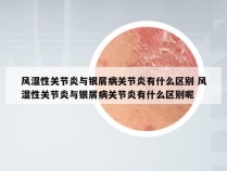 风湿性关节炎与银屑病关节炎有什么区别 风湿性关节炎与银屑病关节炎有什么区别呢