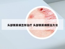头部银屑病怎样治疗 头部银屑病根治方法