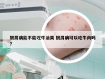 银屑病能不能吃牛油果 银屑病可以吃牛肉吗?