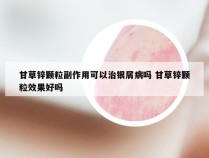 甘草锌颗粒副作用可以治银屑病吗 甘草锌颗粒效果好吗