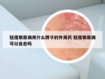 轻度银屑病用什么牌子的外用药 轻度银屑病可以自愈吗