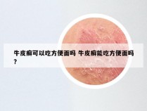 牛皮癣可以吃方便面吗 牛皮癣能吃方便面吗?
