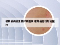 银屑病病哪里最好的医院 银屑病比较好的医院