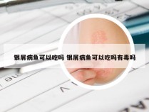 银屑病鱼可以吃吗 银屑病鱼可以吃吗有毒吗