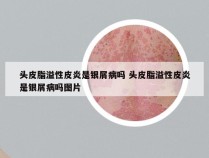 头皮脂溢性皮炎是银屑病吗 头皮脂溢性皮炎是银屑病吗图片