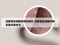 成都银屑病医院哪家最好 成都银屑病医院哪家最好最安全