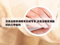 济南治银屑病哪家权威专家 济南治银屑病最好的三甲医院