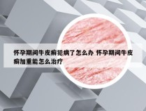 怀孕期间牛皮癣犯病了怎么办 怀孕期间牛皮癣加重能怎么治疗