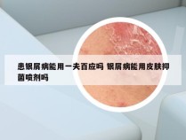 患银屑病能用一夫百应吗 银屑病能用皮肤抑菌喷剂吗