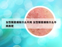女性银屑病有什么不同 女性银屑病有什么不同表现