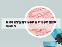 石河子哪家医院专治牛皮癣 石河子市皮肤病专科医院