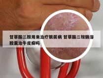 甘草酸二胺用来治疗银屑病 甘草酸二铵肠溶胶囊治牛皮癣吗