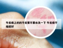 牛皮癣上的的干皮要不要水洗一下 牛皮癣干燥就好