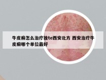 牛皮癣怎么治疗独te西安北方 西安治疗牛皮癣哪个单位最好