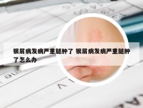银屑病发病严重腿肿了 银屑病发病严重腿肿了怎么办