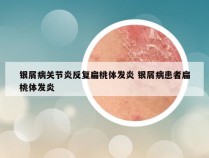 银屑病关节炎反复扁桃体发炎 银屑病患者扁桃体发炎
