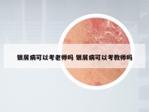 银屑病可以考老师吗 银屑病可以考教师吗
