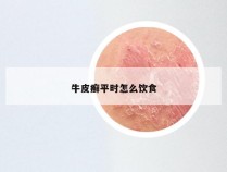 牛皮癣平时怎么饮食