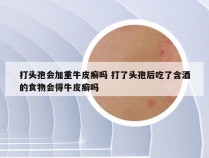 打头孢会加重牛皮癣吗 打了头孢后吃了含酒的食物会得牛皮癣吗
