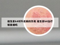 维生素k4对牛皮癣的作用 维生素k4治疗银屑病吗