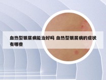 血热型银屑病能治好吗 血热型银屑病的症状有哪些