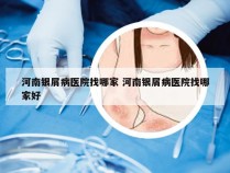 河南银屑病医院找哪家 河南银屑病医院找哪家好