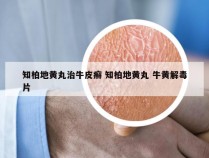 知柏地黄丸治牛皮癣 知柏地黄丸 牛黄解毒片