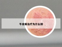 牛皮癣治疗为什么别