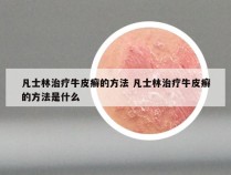 凡士林治疗牛皮癣的方法 凡士林治疗牛皮癣的方法是什么