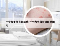 一个大手指有银屑病 一个大手指有银屑病图片