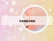 牛皮癣能长寿吗
