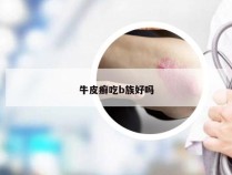 牛皮癣吃b族好吗
