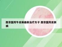 西京医院牛皮癣最新治疗方子 西京医院皮肤病