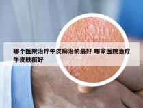 哪个医院治疗牛皮癣治的最好 哪家医院治疗牛皮肤癣好