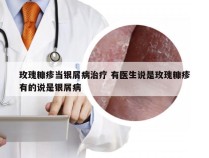 玫瑰糠疹当银屑病治疗 有医生说是玫瑰糠疹有的说是银屑病