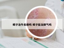 蝎子治牛皮癣吗 蝎子能治脚气吗