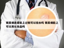 银屑病患者脸上过敏可以挂水吗 银屑病脸上可以用化妆品吗
