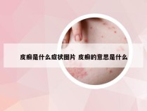 皮癣是什么症状图片 皮癣的意思是什么