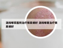 洛阳哪家医院治疗银屑病好 洛阳哪里治疗银屑病好
