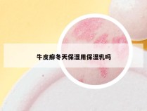 牛皮癣冬天保湿用保湿乳吗