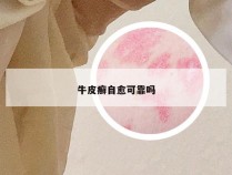 牛皮癣自愈可靠吗