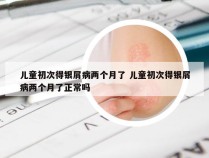 儿童初次得银屑病两个月了 儿童初次得银屑病两个月了正常吗