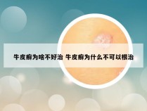 牛皮癣为啥不好治 牛皮癣为什么不可以根治