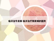 临沂治牛皮癣 临沂治疗银屑病的医院