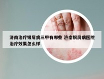 济南治疗银屑病三甲有哪些 济南银屑病医院治疗效果怎么样