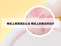 眼皮上银屑病怎么治 眼皮上的癣怎样治疗