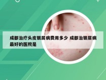 成都治疗头皮银屑病费用多少 成都治银屑病最好的医院是