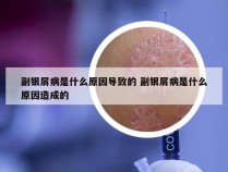 副银屑病是什么原因导致的 副银屑病是什么原因造成的